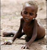 Malnourished child at Wajir District hospital in Kenya